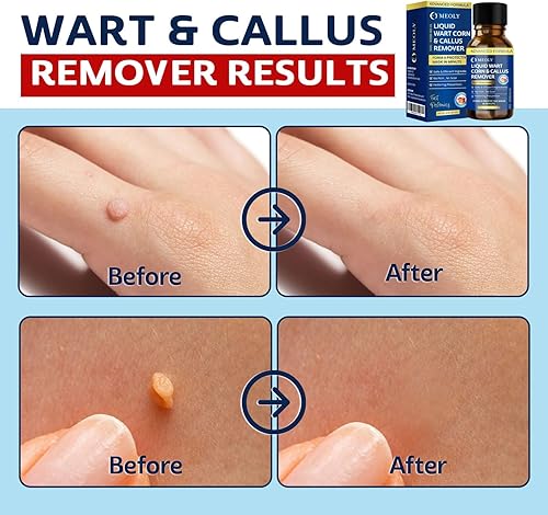 Miniatura 4 de Eliminador de verrugas de acción rápida: removedor de verrugas de ácido salicílico para verrugas plantares, congelación de maíz de acción rápida