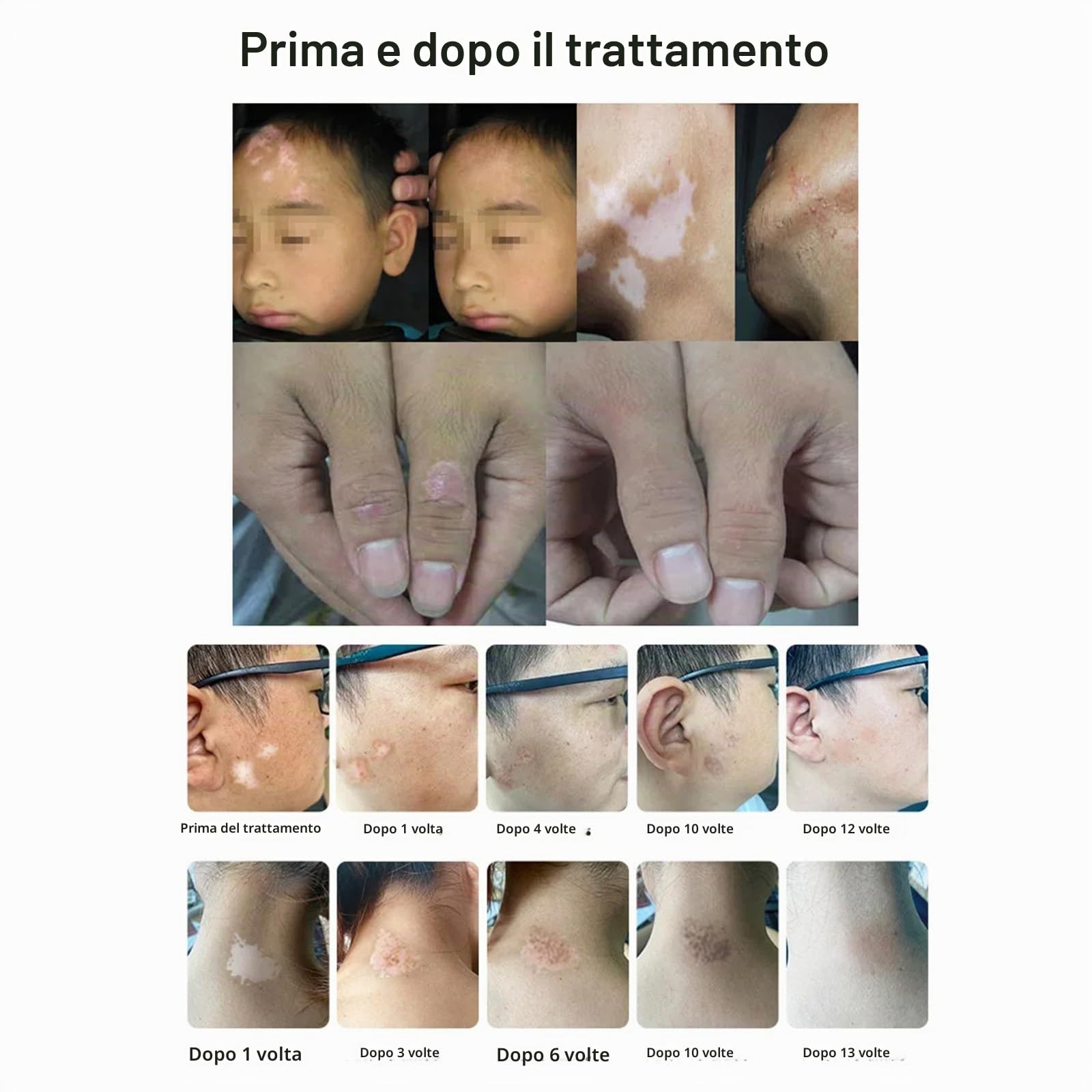Generico Terapia della Luce UVB con Due lampadine: Lampada UV di fototerapia a Banda Stretta da 311 NM, Area 104cm², Timer, Display LCD.Trattamento per Tutto Il Corpo Sicuro ed Efficace