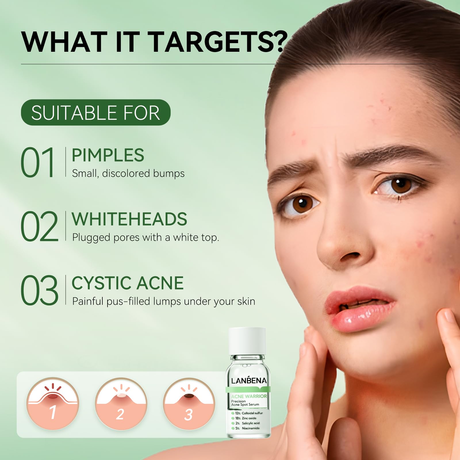 LANBENA Precision Acne Treatment Spot Serum, Drying Lotion, Overnight Acne Treatment for Face Dry Out Pimples, Blemishes - Image 3