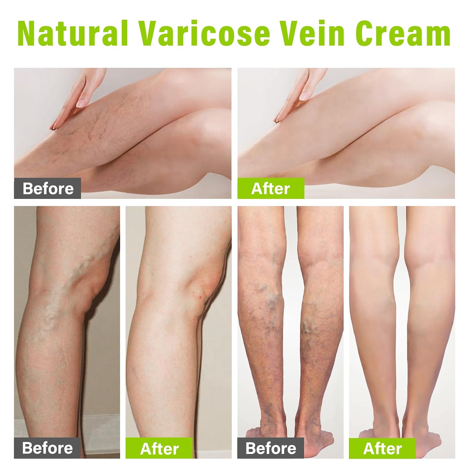 Varicose Veins Treatment for Legs, Varicose Veins Cream to Treat Varicose, Spider Veins & Improves Circulation, Protect Vascular Health, 40g