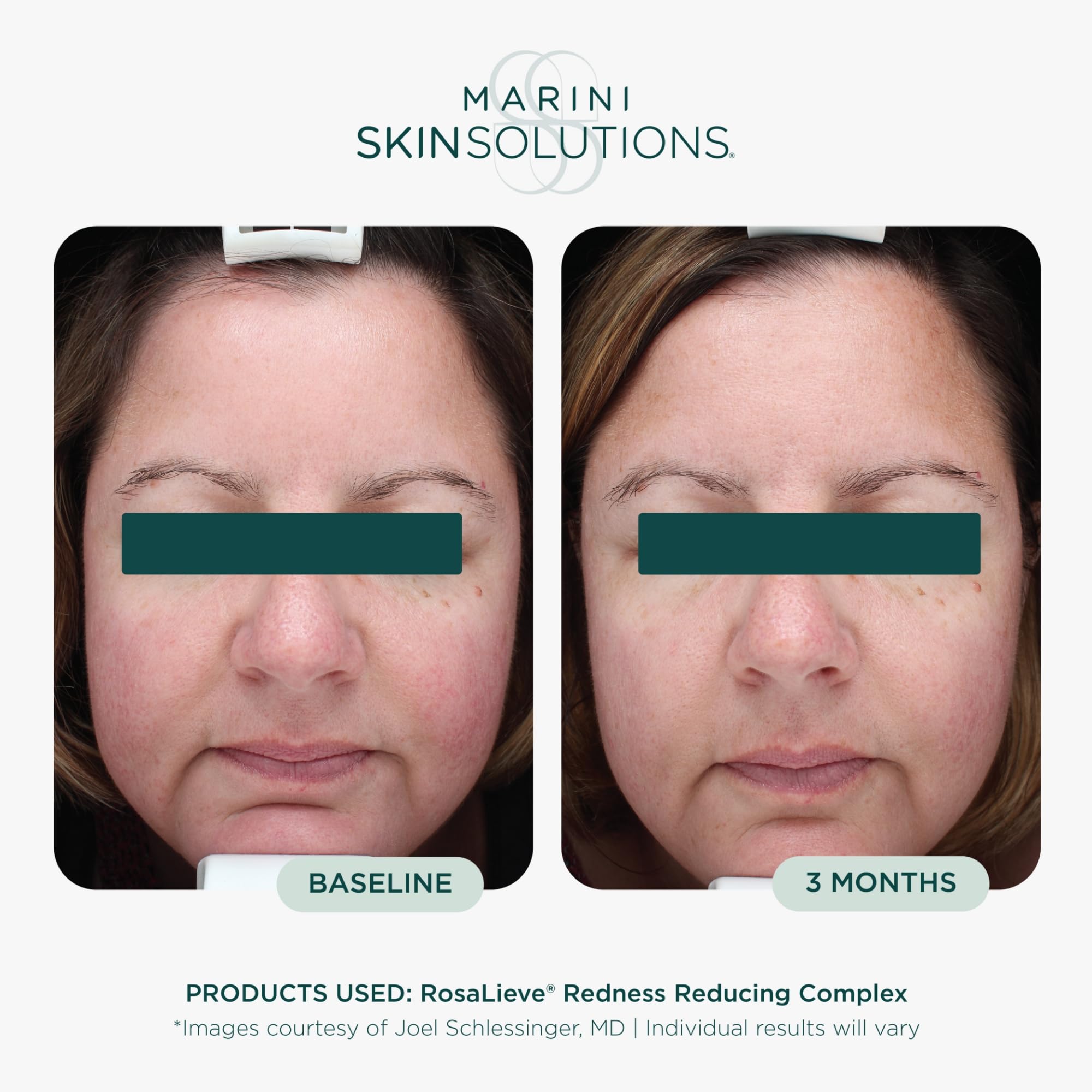 Amazon.com: Marini SkinSolutions RosaLieve - Redness Reducing Face