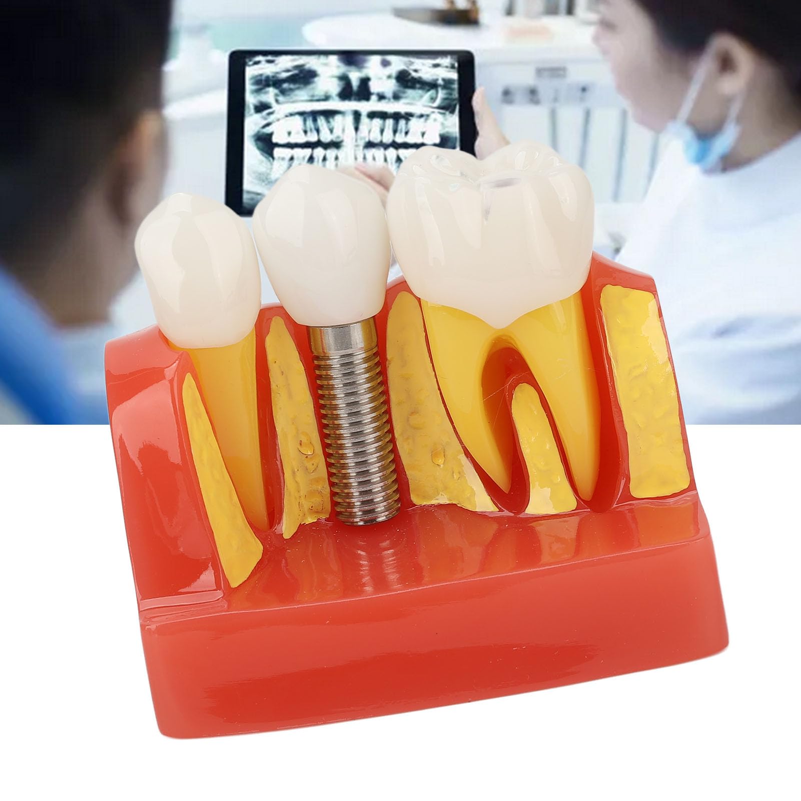 Modelo de implante Dental con Corona y Puente extraíbles para demostración y formación