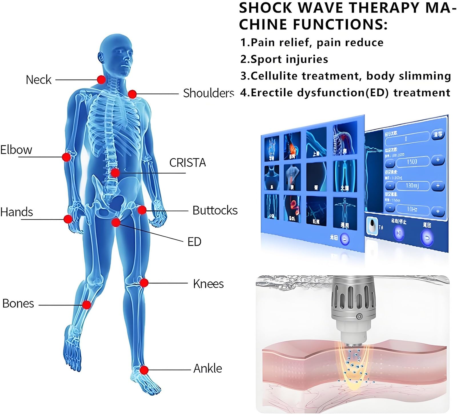Generic Macchina extracorporea di terapia di Wave di urto per uso medico