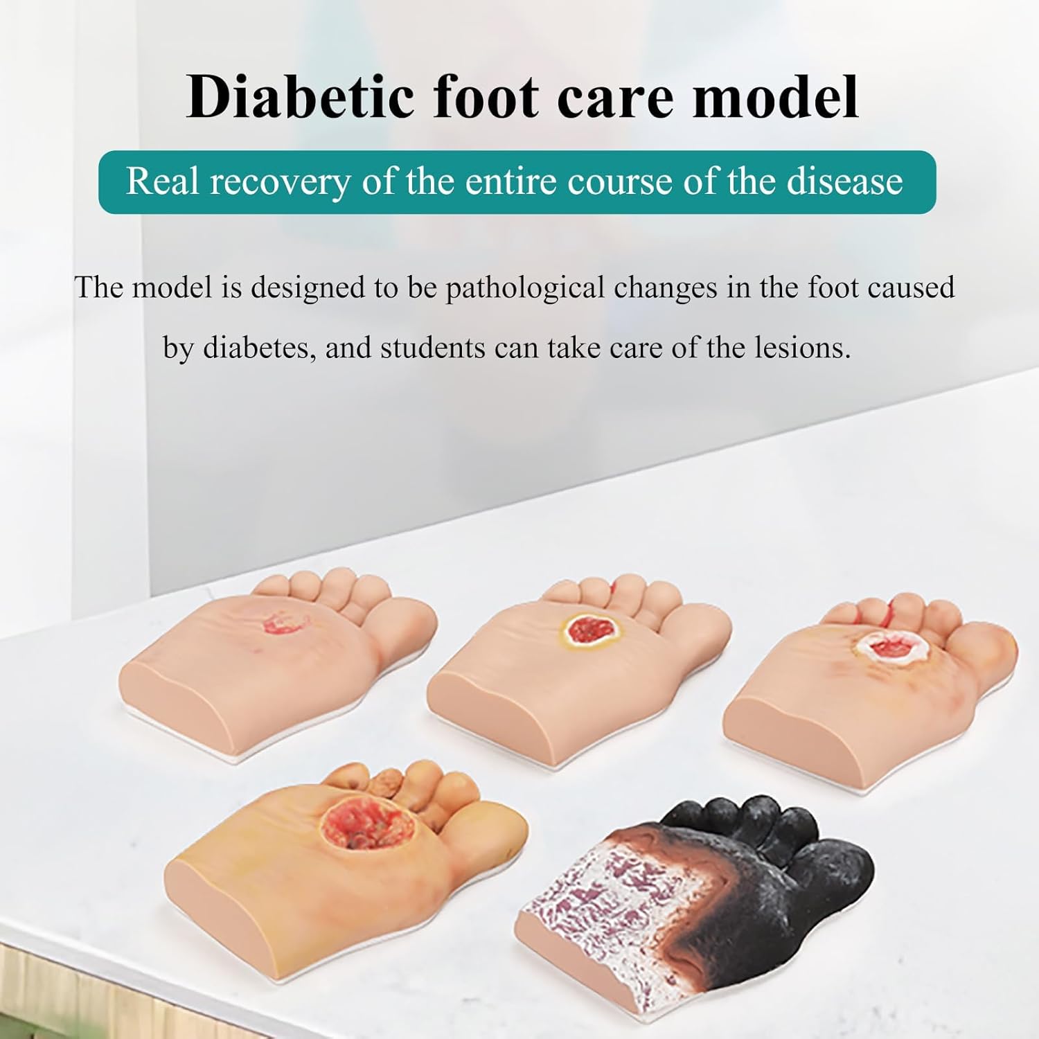COYEUX Diabetic Foot Care Model, 1-5 Diabetic Foot Simulator, Diabetic & Geriatric Nursing Tool, for Patient Education and Science Study