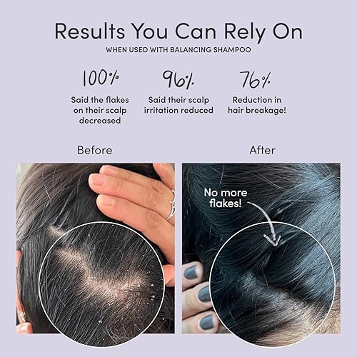 Miniatura 3 de Jupiter Suero anticaspa para cuero cabelludo  Deja en tratamiento restaurador para cuero cabelludo seco picazón y graso  Aloe Vera y niacinamida