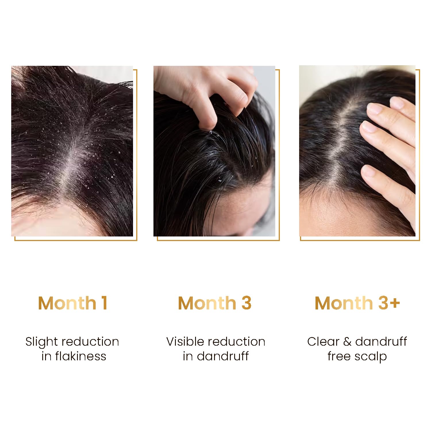 The Skin Story Anti-Dandruff Serum | Clean and Russian-free skulls | Reduces bunch, skull dryness and irritation. Promises healthy hair growth. Saniscalp & Evosina Gp Green | Non-Rasila | All hair types The Skin Story Anti-Dandruff Serum | Clean and Russian-free skulls | Reduces bunch, skull dryness and irritation. Promises healthy hair growth. Saniscalp & Evosina Gp Green | Non-Rasila | All hair types