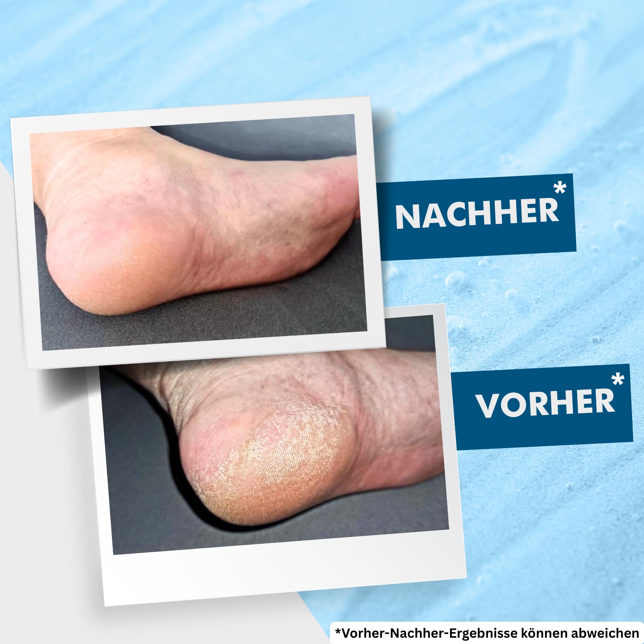 Lopalmed® Hornhaut & Nagelhaut Testbox [Sanfte & schnelle Anwendung!] – Hornhautentfernung ohne Raspel – Fußpflege gegen Hornhaut & Schwielen (Dermatologisch getestet & vegan)