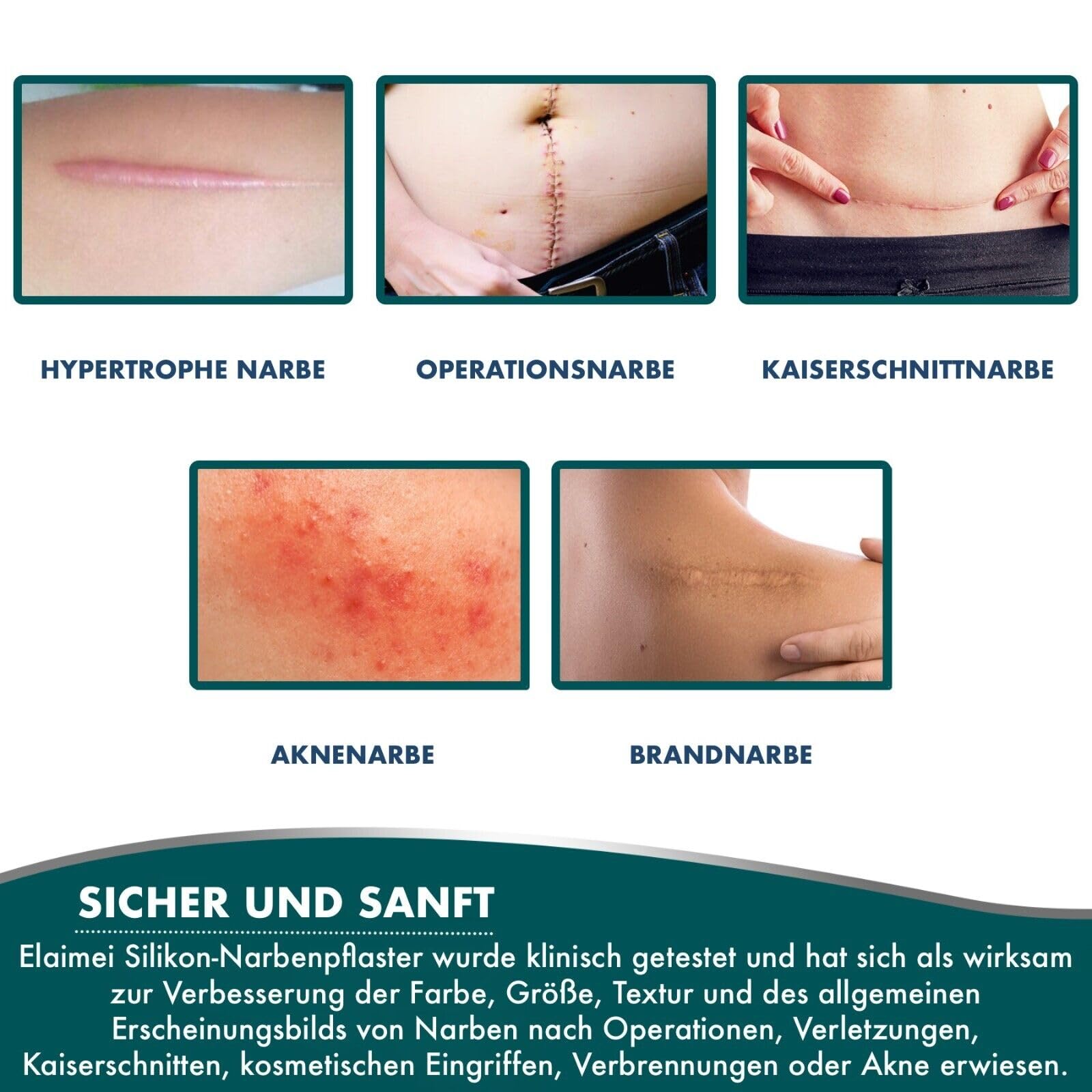 P-Beauty Silikonpflaster zur Narbenreduktion 4cm x 3,2m | Selbstklebendes, medizinisches Narbenpflaster | wiederverwendbar | gegen Akne, Keloid, OP & Verbrennungsnarben | Silikon Narbenrolle