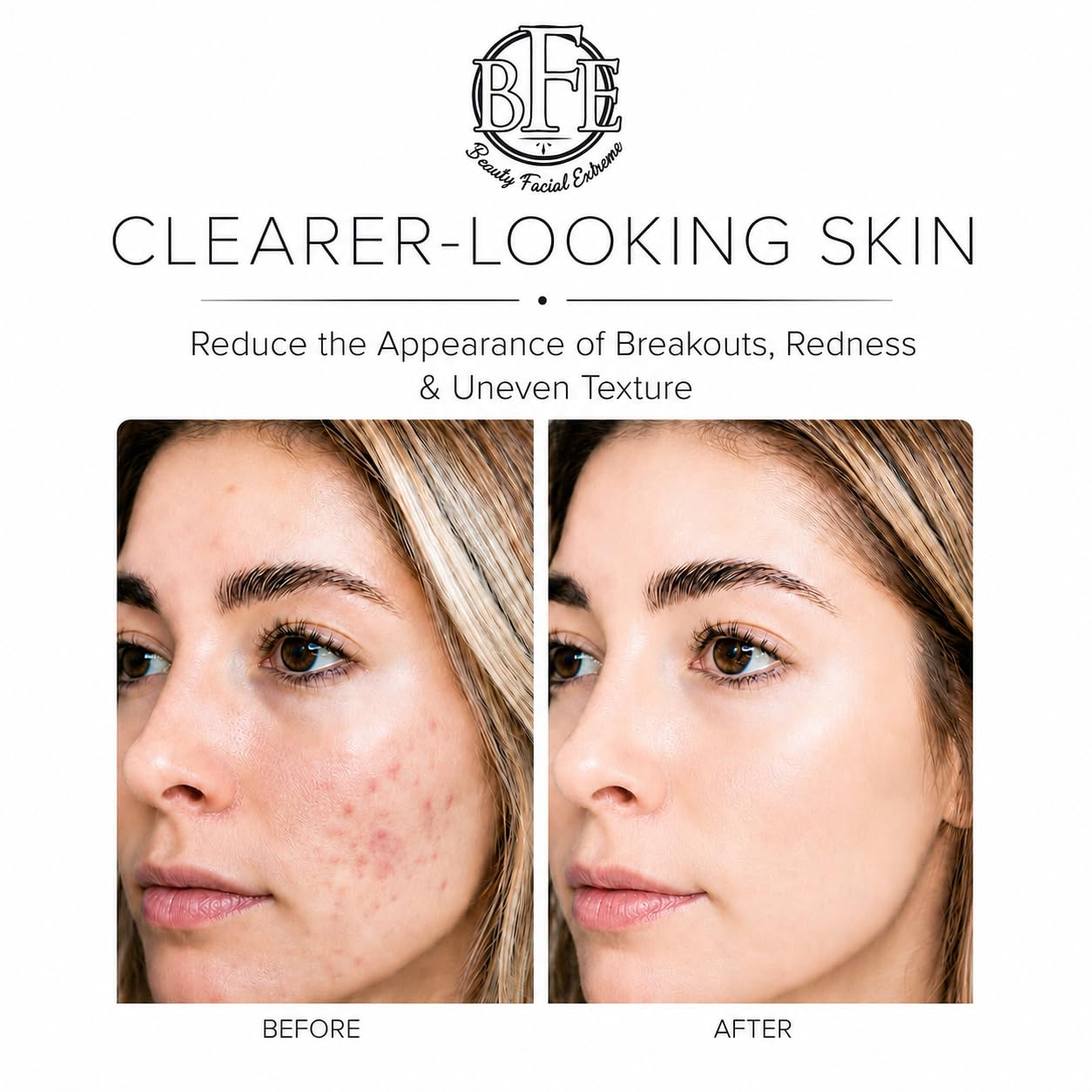 Acne Treatment Pads with Salicylic, Glycolic & Lactic Acids