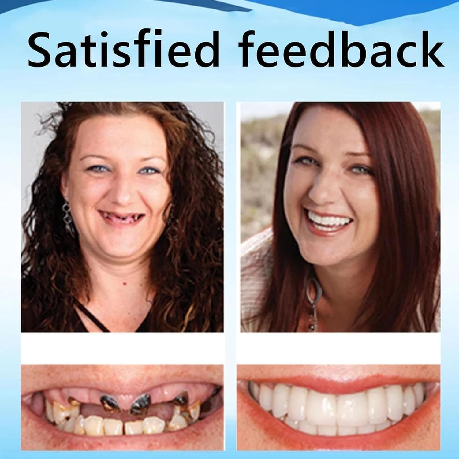 Protesi Dentaria, Dentiere in Silicone (Arcata Superiore e Inferiore), Morbide e Confortevoli, Faccette a Incastro (Snap-on), Denti in Silicone da Applicare sopra i Denti Esistenti (2Pezzo)