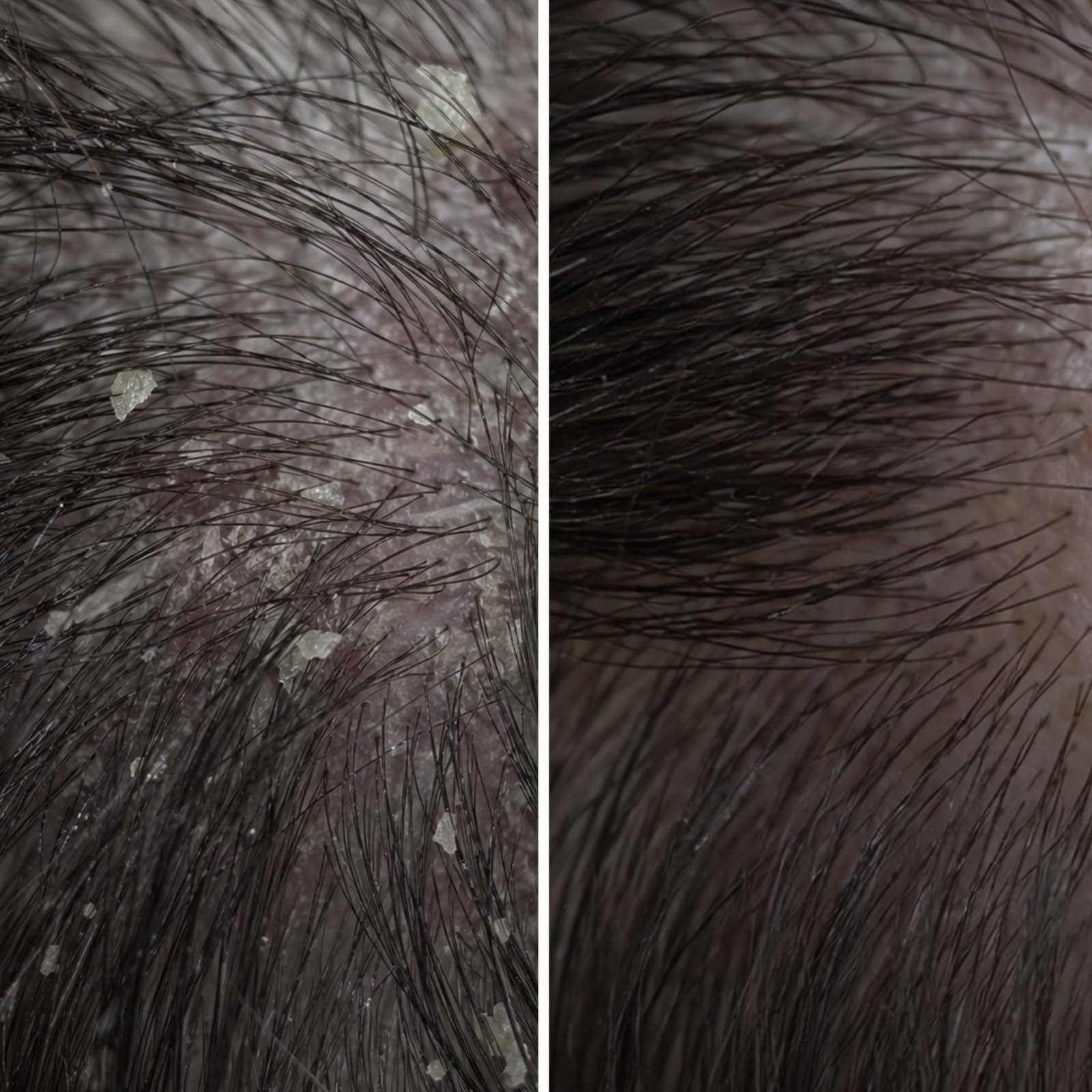 Peeling Cuoio Capelluto all'Acido Salicilico contro Forfora, Prurito & Secchezza - Trattamento Pre-Lavaggio 10 Minuti Esfolia & Pulizia Profonda con Acido Salicilico & Piroctone Olamine - 150 ml