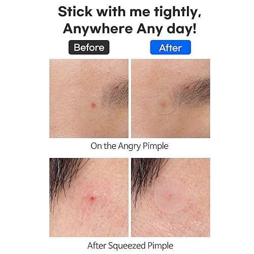 Miniatura 8 de TIAM Surprise B Parche (120 unidades, paquete de 5), parche hidrocoloide para acné