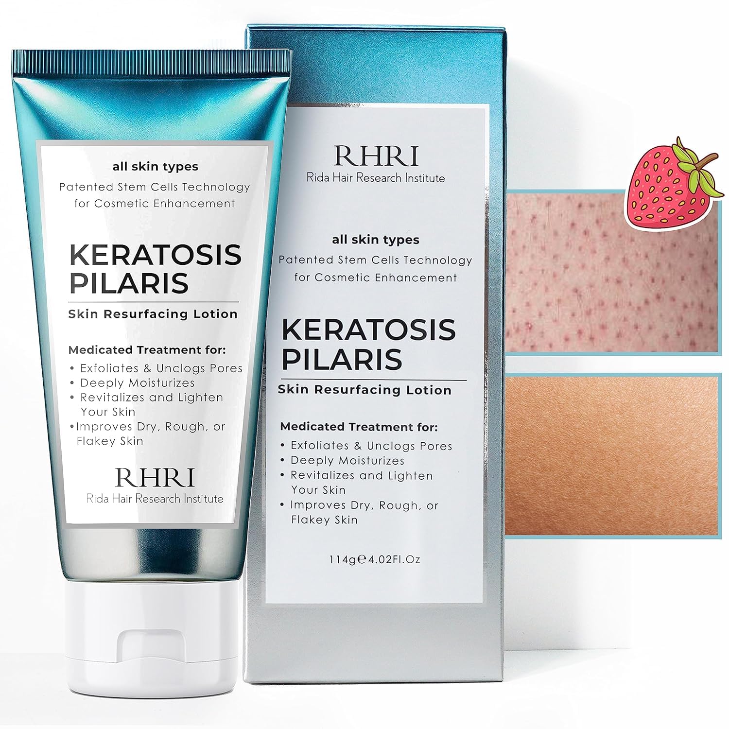 Keratosis Pilaris Lotion with Glycolic Acid, AHA & BHA Exfoliating | Strawberry Legs, KP & Ingrown Hair Treatment | Bumpy Skin Body Lotion | Moisturizing Cream for Redness, Dry, Rough & Flakey Skin