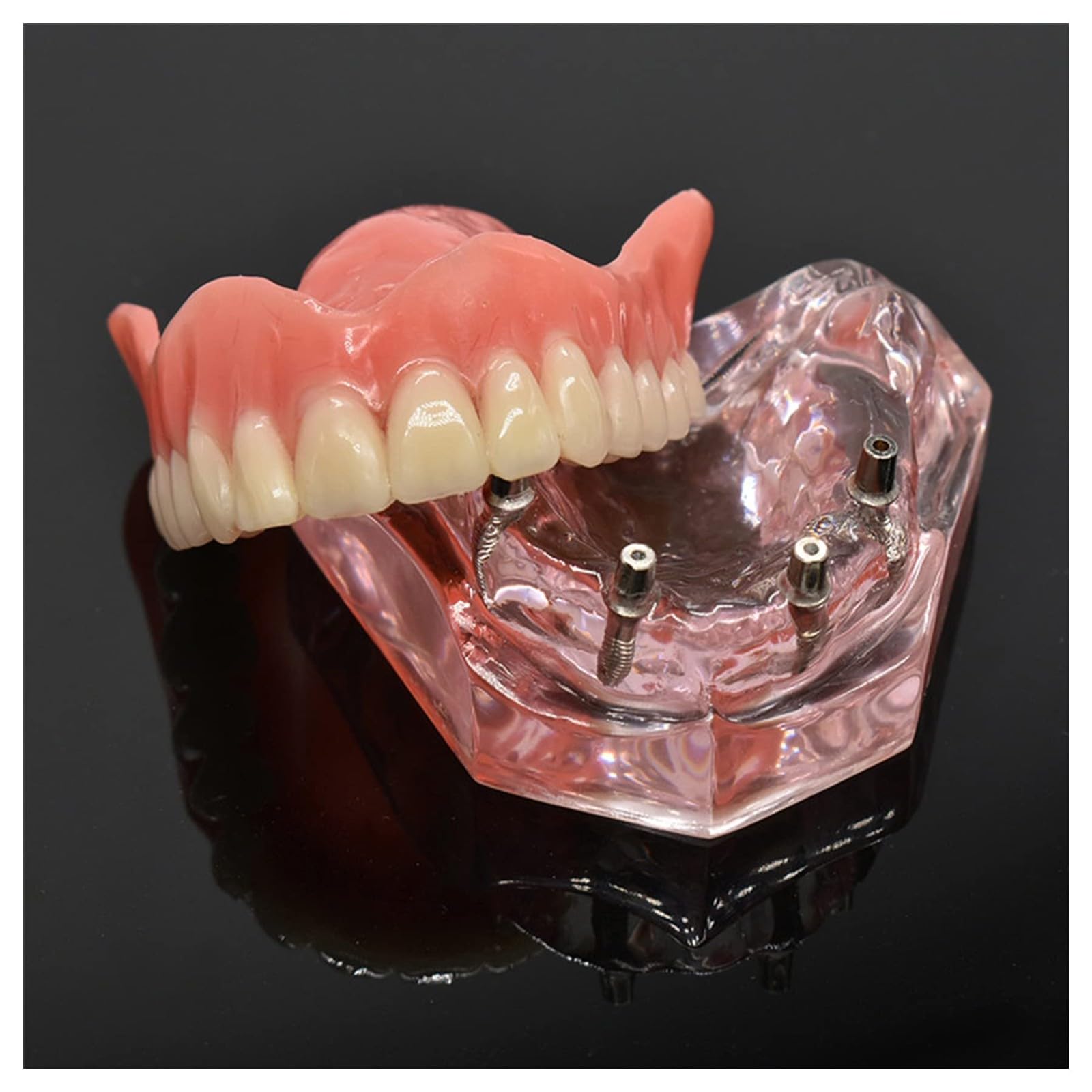 Modelo de dientes para implantes dentales tipodonto, rosa transparente, restauración de implantes dentales tipodonto, sobredentadura, 4 implantes, superior, demostración para estudio y enseñanza.