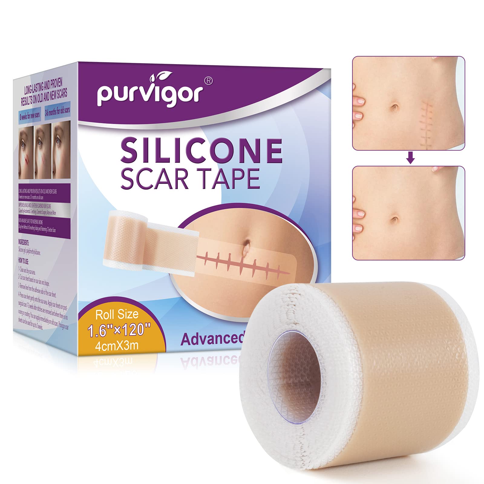 Silicone Scar Sheets, Silicone Scar Tape (3m), Scar Tape for Surgical Scars and C-section & Surgery, Burns, Acen scars, Stretch Marks, Keloid et (1.6” x 120” Roll-3M)