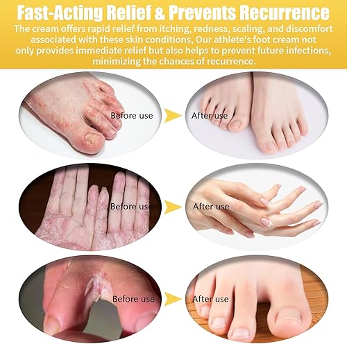 Miniatura 5 de 1 paquete de alivio de la picazón en los pies, la piel de la boca y la mano del pie, crema calmante, especial para picazón deportista, olor de pies,