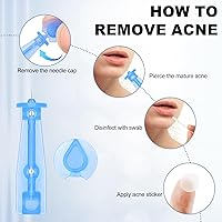 Vista 4 de Agujas estériles para espinillas, 100 agujas desechables para el acné y 144 puntos adhesivos para espinillas, herramientas efectivas para eliminar