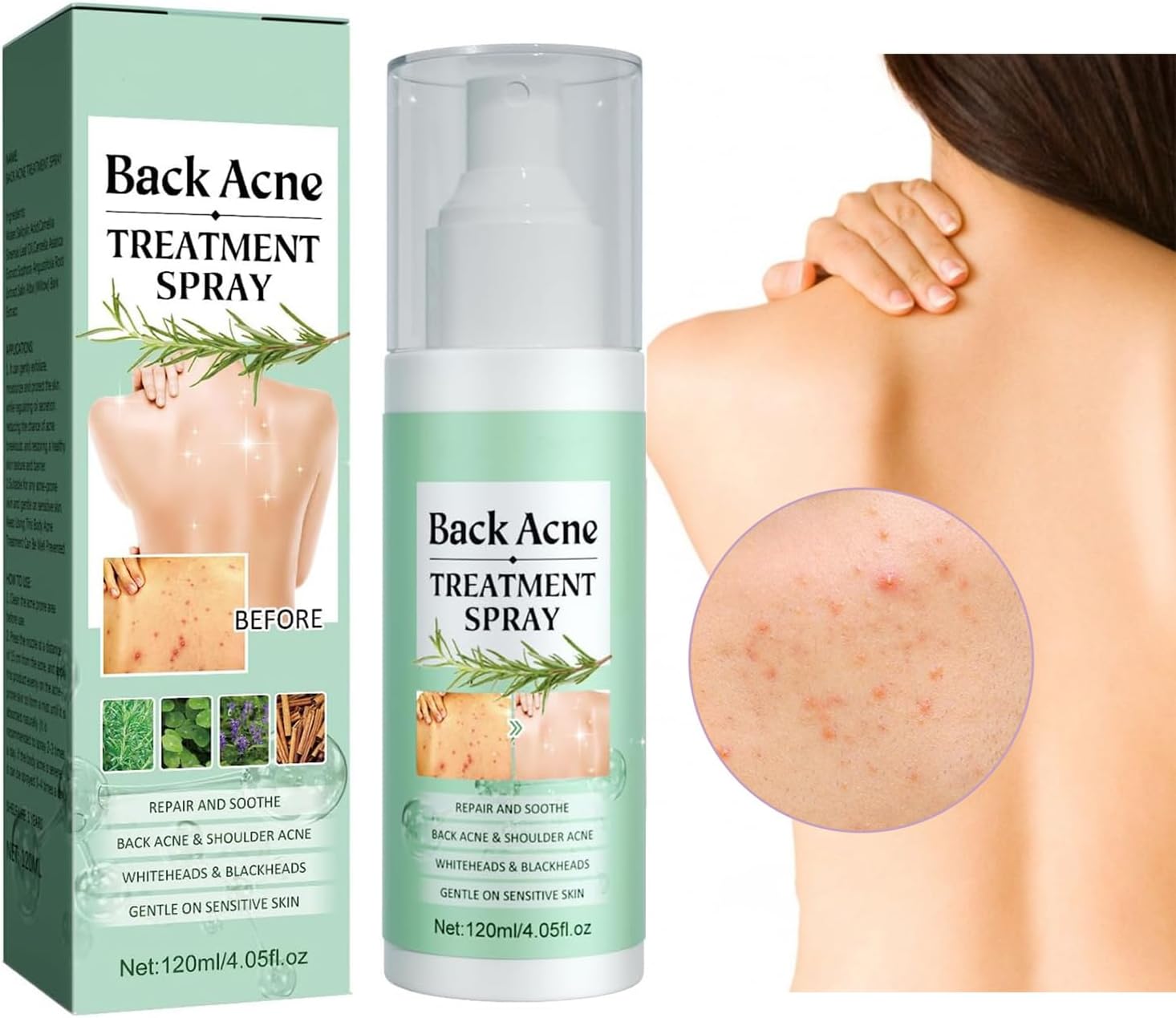 Back Acne Treatment Spray, Body Acne Spray Gentle Acne Oil Control Redness Smooth Skin Cleans Pores Moisturizes Easy to Use and Quick Dry Formula,Gentle on Skin, Care for Chest & Butt Acne