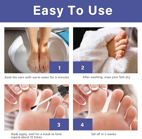 Miniatura 7 de Vifycim Removedor de maíz para pies, alivio del dolor de maíz extra fuerte para pies, dedos de los pies, manos, maíz de pies y callos, acción rápida