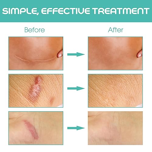 Miniatura 6 de Cinta de silicona suave de grado médico para eliminación de cicatrices (1 x 120 pulgadas), 1 rollo de 70.9 in con hojas de cicatriz de silicona de