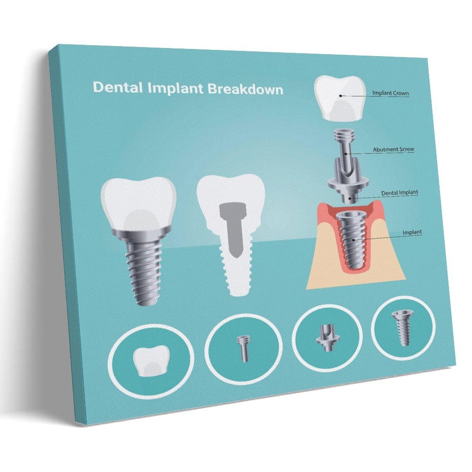 Guidelines for Dental Implants Canvas Wall Art Prints Gifts Photo Picture Paintings Room Decor Home Decorative 24x36inch(60x90cm)