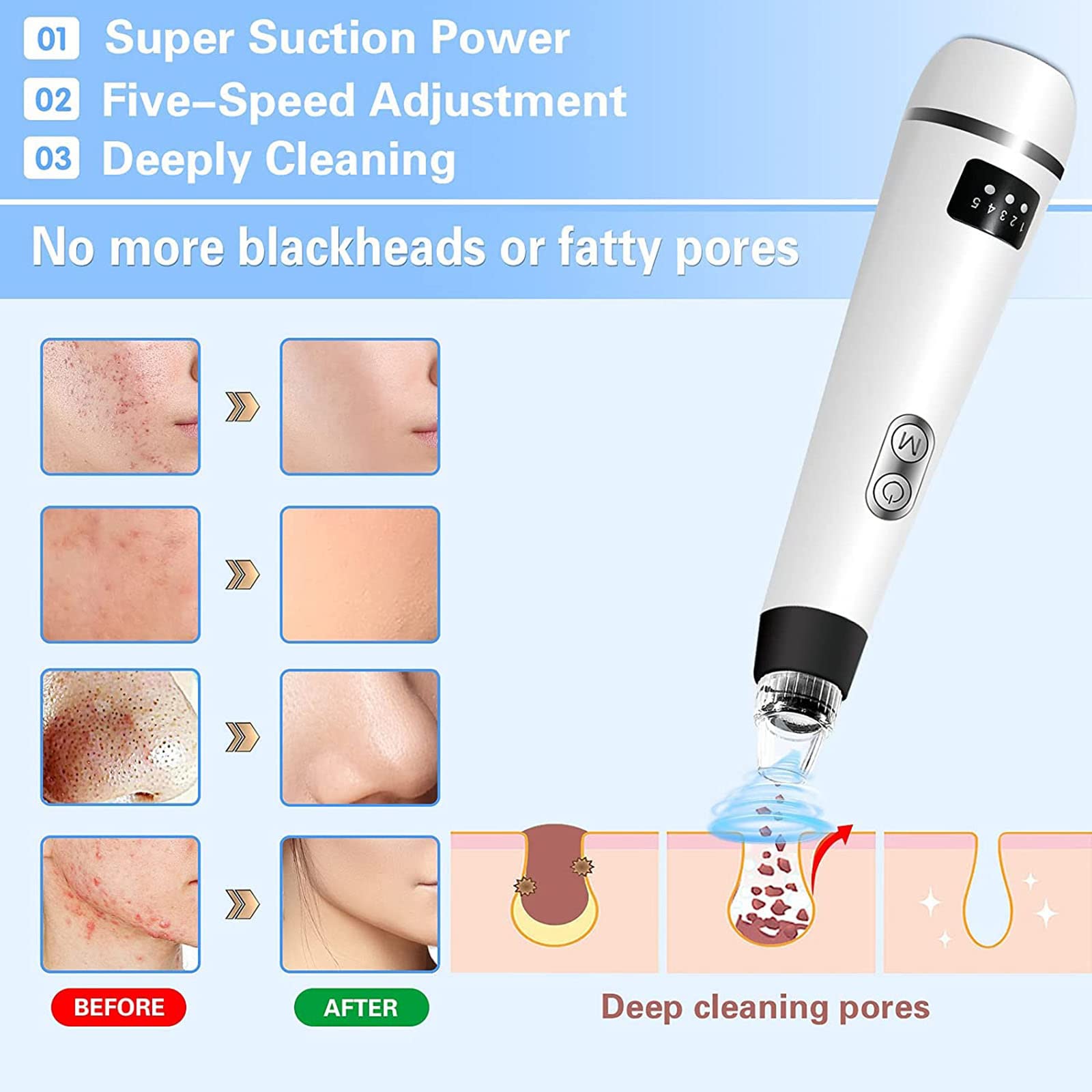 Limpiador facial de poros, limpiador eléctrico de poros, herramienta de succión de puntos negros, herramienta de extracción de puntos blancos, extractor de espinillas de limpieza facial, removedor de