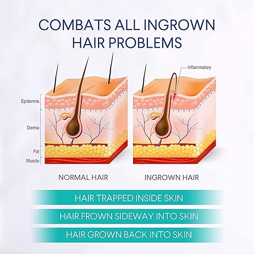 Miniatura 4 de Tratamiento de golpes de afeitar para mujeres y hombres, tratamiento para el cabello encarnado, tratamiento de golpes de afeitar para área del