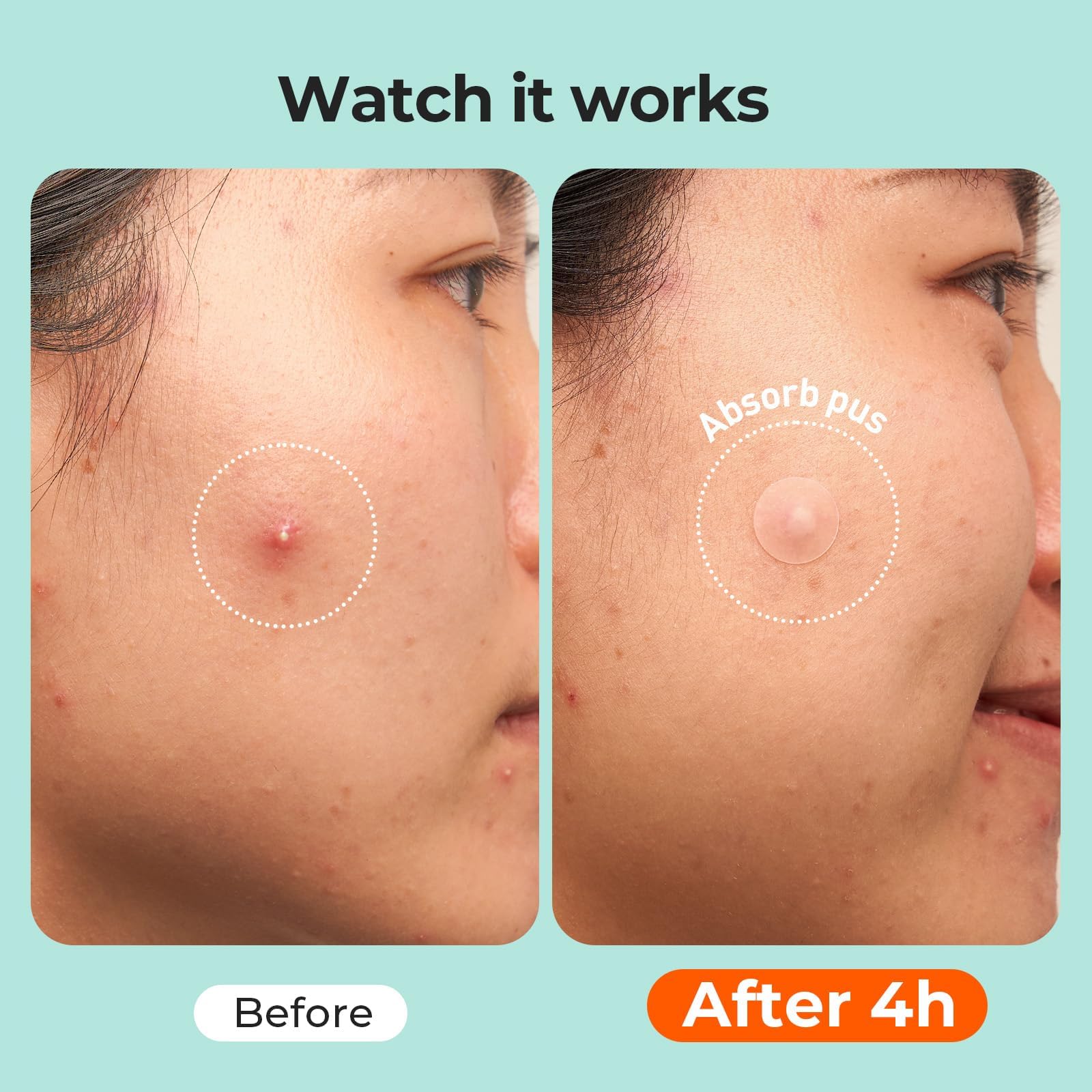 TKTK 443 Count Pimple Patches for Face, Hydrocolloid Acne Patch Bulk, Acne Stickers for Covering Cheeks, Forehead, Chin Blemishes Zit Breakouts for All Skin Types (Dots, Strip, Contoured 5 Sizes) — view 6