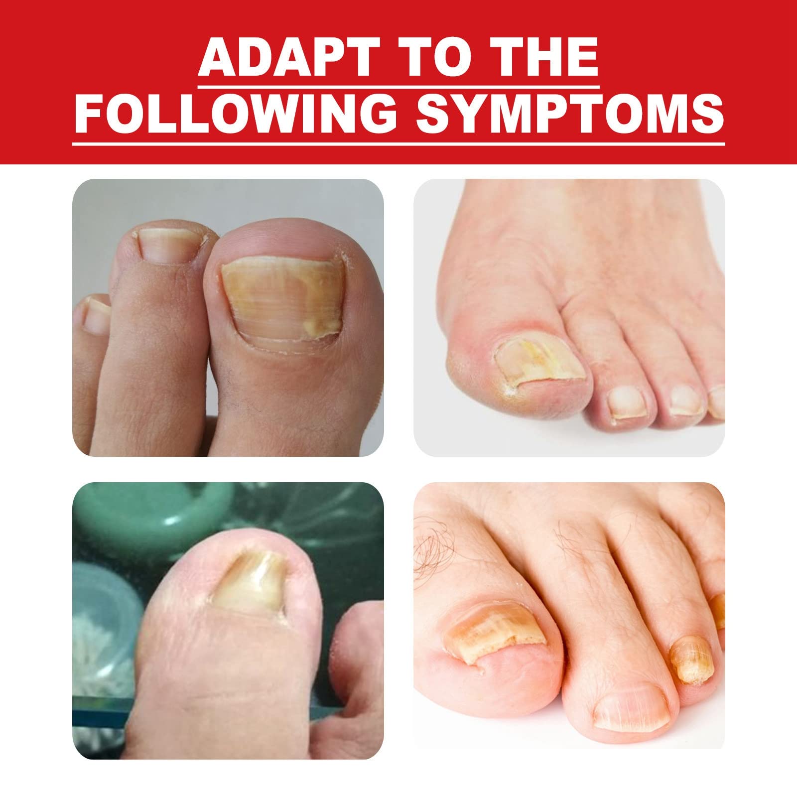 HIVETZ Ingrown Toenail Treatment,Nail Helper,Nail Growth Treatment,Ingrown Toenail Drops,Cuticle Nail Oil,Ingrown Toenail Correction,Fungal Nail Treatment for Toenails Extra Strong for Damaged Nails - Image 2