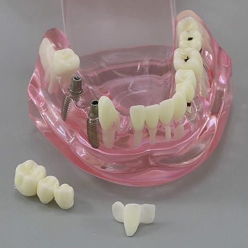 Miniatura 9 de Demostración oral del puente de la patología del color rosado de los dientes de Typodont de la restauración del implante dental M2001 para el