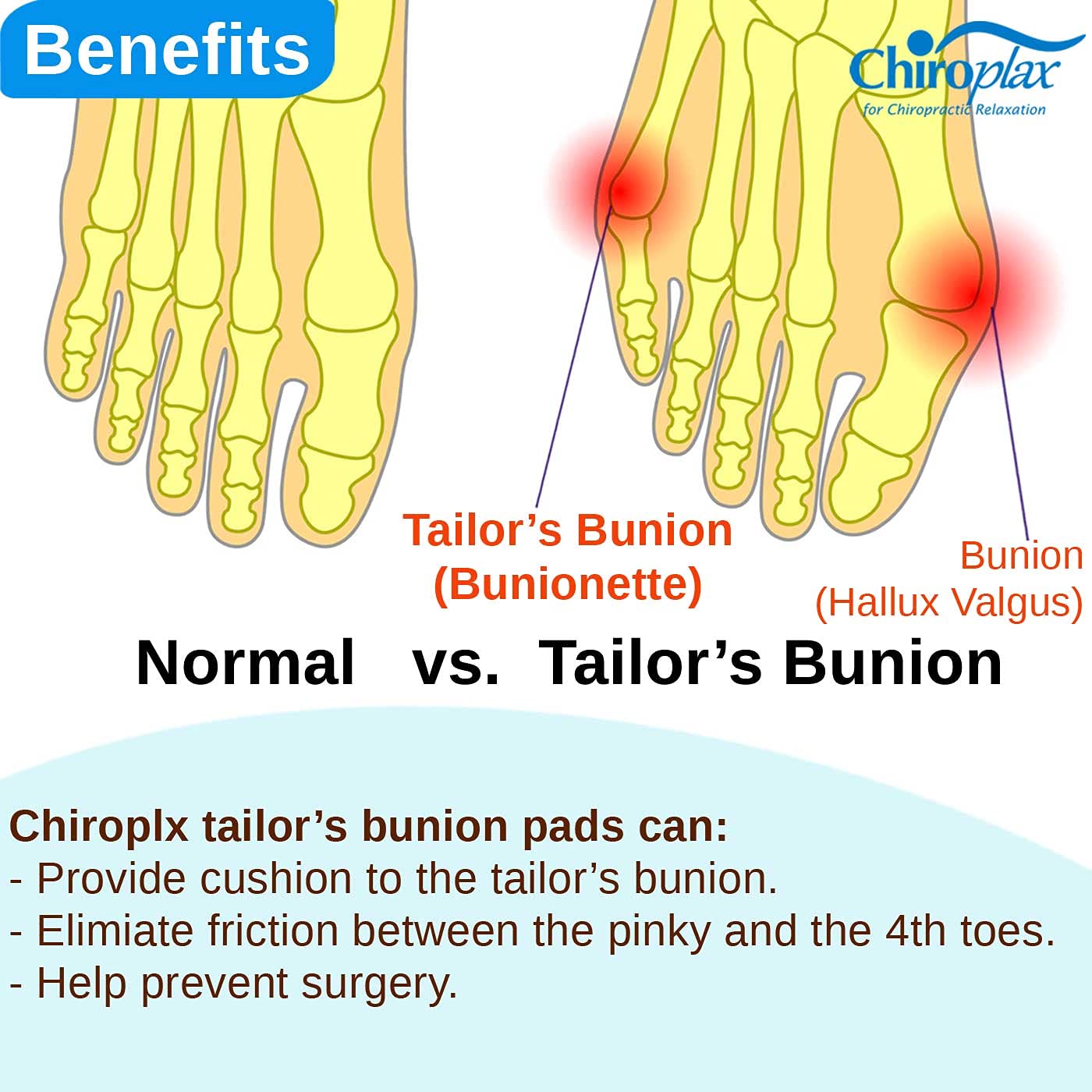 Chiroplax Bundle - 6 Tailor's Bunion Pads (Size M) + 4 Double Loop Pinky Toe Spacers (Size S)