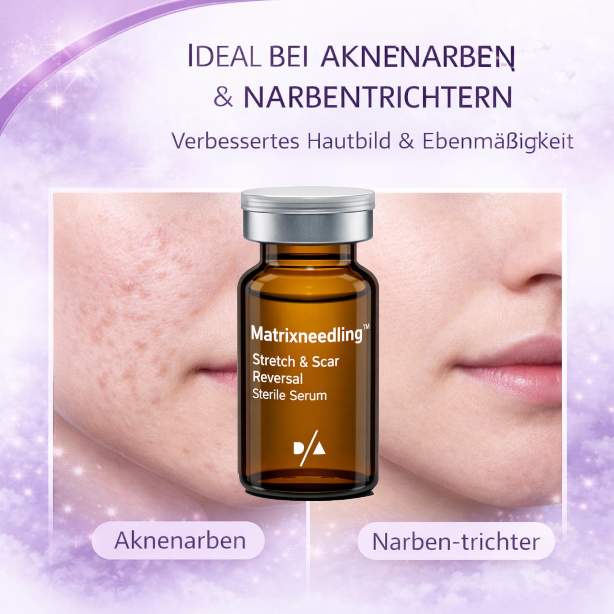 Matrixneedling™ Stretch & Scar Reversal – Microneedling Serum gegen Narben & Dehnungsstreifen – Aknenarben Serum & Kollagen Booster – Dermapen & Dermaroller Narbenbehandlung für glattere Hautstruktur