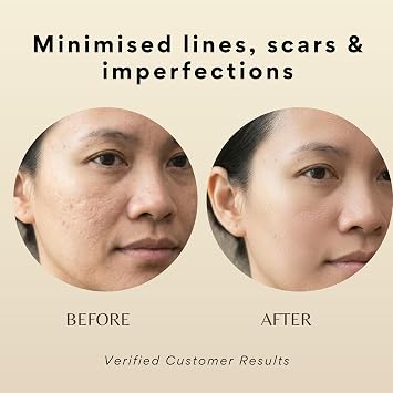 Derma Stamp Pro – Adjustable Microneedling Tool | 140 Titanium Micro Pins for Collagen Boost, Beard & Hair Growth, Acne Scars, Fine Lines & Stretch Marks | Professional Derma Pen Alternative