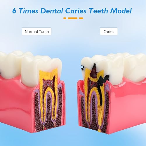 Miniatura 2 de Modelo de dientes de caries dentales - 6 veces anatomía de caries Modelo de dientes de cuidado dental Modelo de caries Modelo de educación