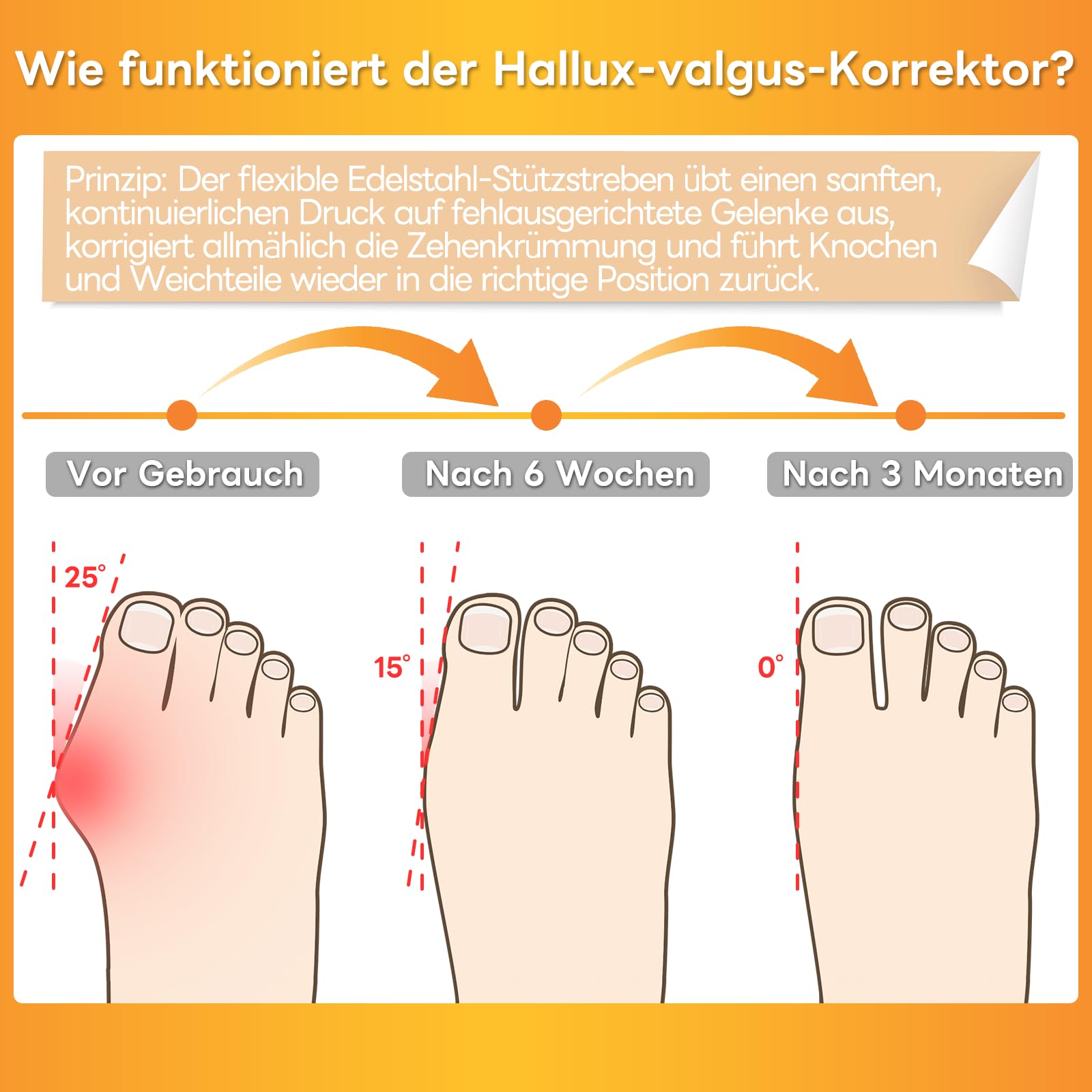 InhwRior Hallux-valgus-Korrektor mit 4 flexiblen rostfreien Stahlstreifen (je 2 pro Seite), ​​Silikonschutzkissen zur Polsterung, ​​schmerzfreie Verbesserung des Fußzustands, ​waschbar