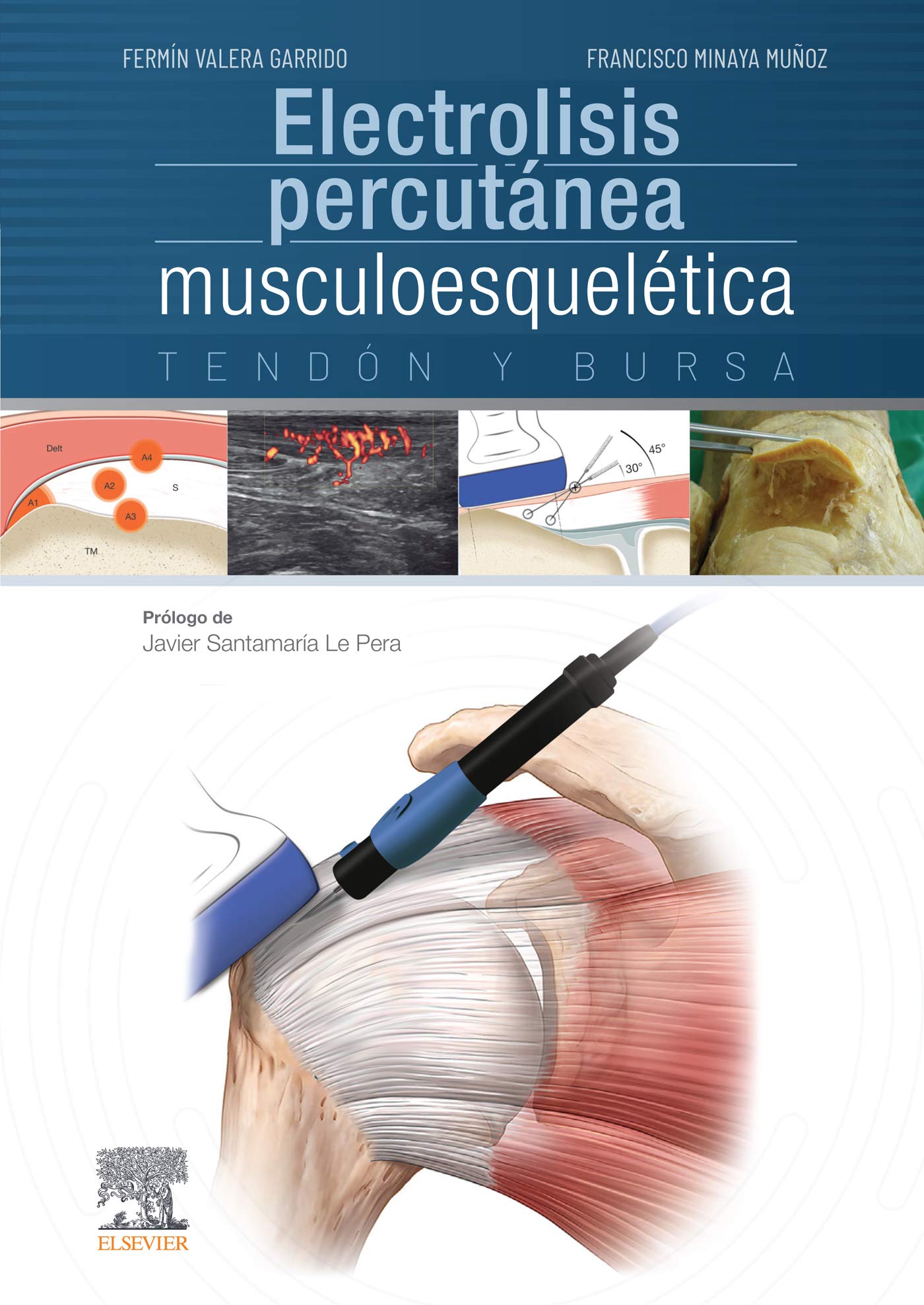 Electrolisis percutánea musculoesquelética (Spanish Edition)