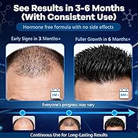 Vista 6 de Espuma tópica de minoxidil al 5 %, aerosol de minoxidil para hombres, impregnado con biotina, tratamiento para el crecimiento del cabello, apoya