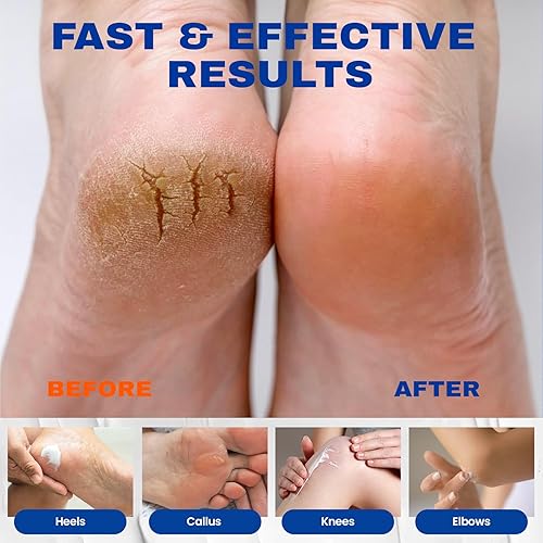 Miniatura 3 de SKIN ULTIMA Crema de urea 40 porciento más 2% ácido salicílico, 40% crema de urea para pies de máxima potencia, crema de pies para pies secos