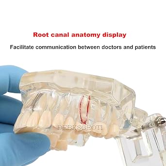 Dental Implant Models Restoration Typodont Teeth Tooth Model Demo Oral Pathology Bridge Teach Study Clear Color M2001