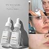 Niacinamide 10% + Zinc 1% Serum for Women, 30 ml / 1 Fl Oz Refreshing Niacinamide Serum for Face, Niacinamide Face Serum for Acne