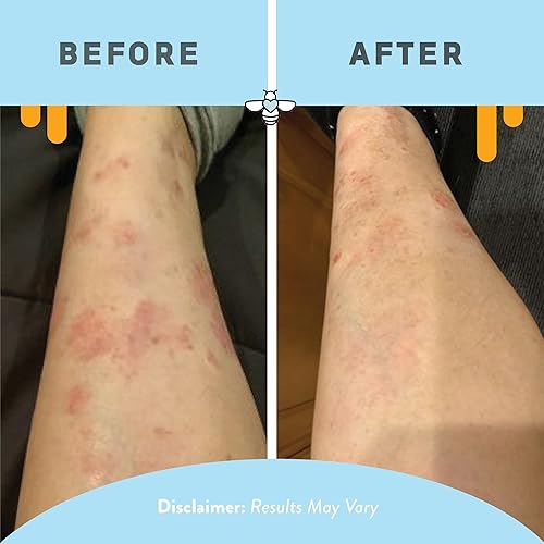 Miniatura 5 de Loción corporal hidratante diaria - Crema antipicazón de día y noche - Tratamiento de psoriasis para la piel - Ungüento para aliviar la picazón -