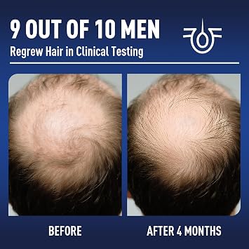 5% Minoxidil Hair Growth With Biotin: Minoxidil for Men and Women - Hair Growth Supports Thicker er Beard & Hair(2 Pack 4Oz For 4 Month Supply)