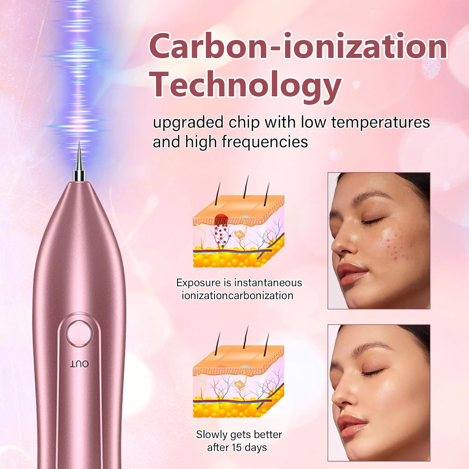 Skin Tag Remover Device FDA-Cleared Safe and Effective Skin Tag Removal Kits Home Use