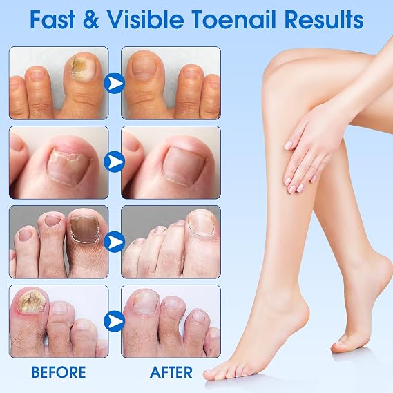 EASICUTI Fungal Nail Patches, 60 PCS Toenail Fungus Treatment Extra Strong