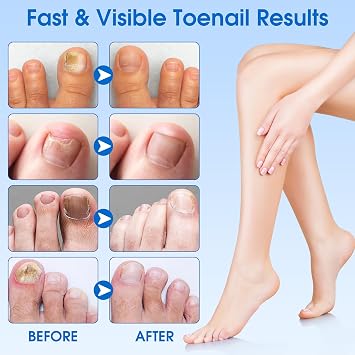 EASICUTI Fungal Nail Patches, 60 PCS Toenail Fungus Treatment Extra Strong
