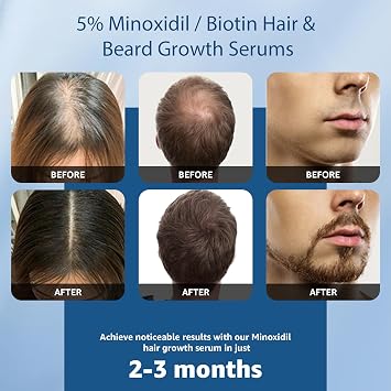 5% Minoxidil with Biotin for Men and Women, Hair & Beard Growth Serum, Topical Minoxidil Solution for Thinning Hair Loss,Extra Strength, 2 Pack