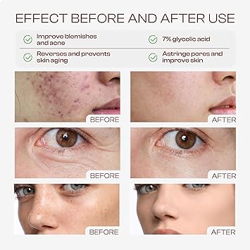 Glycolic Acid Toner: 240ml Glycolic Acid 7% Exfoliating Toner Toning Solution Which Soothes and Hydrates Skin