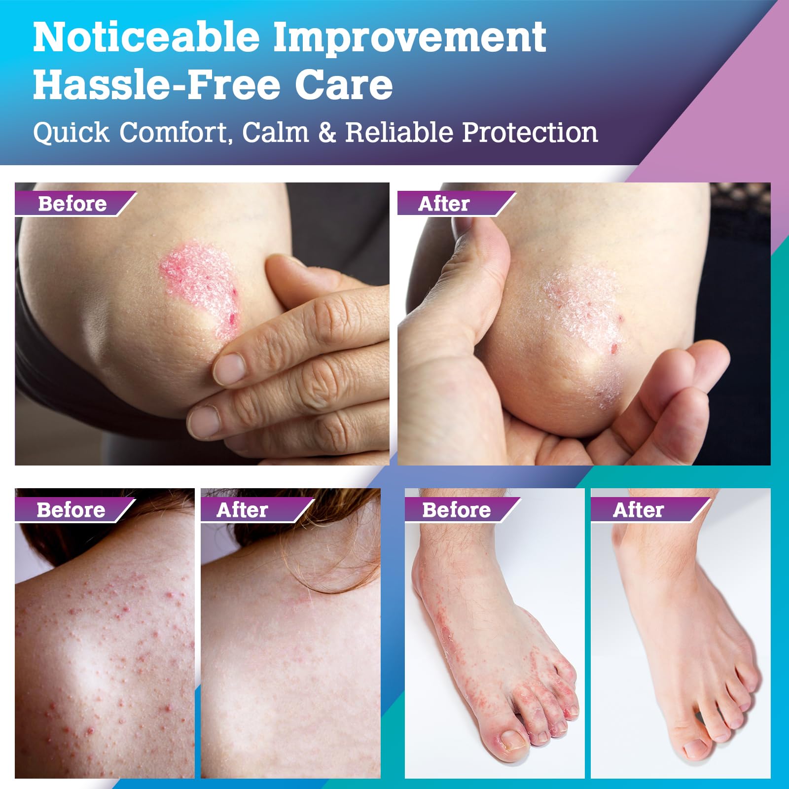 Crema Antimicotica Piedi Pelle Antiprurito: Trattamento Topico per Piedi, Inguine, Ascelle e Pieghe Cutanee – Comfort, Protezione e Igiene Quotidiana