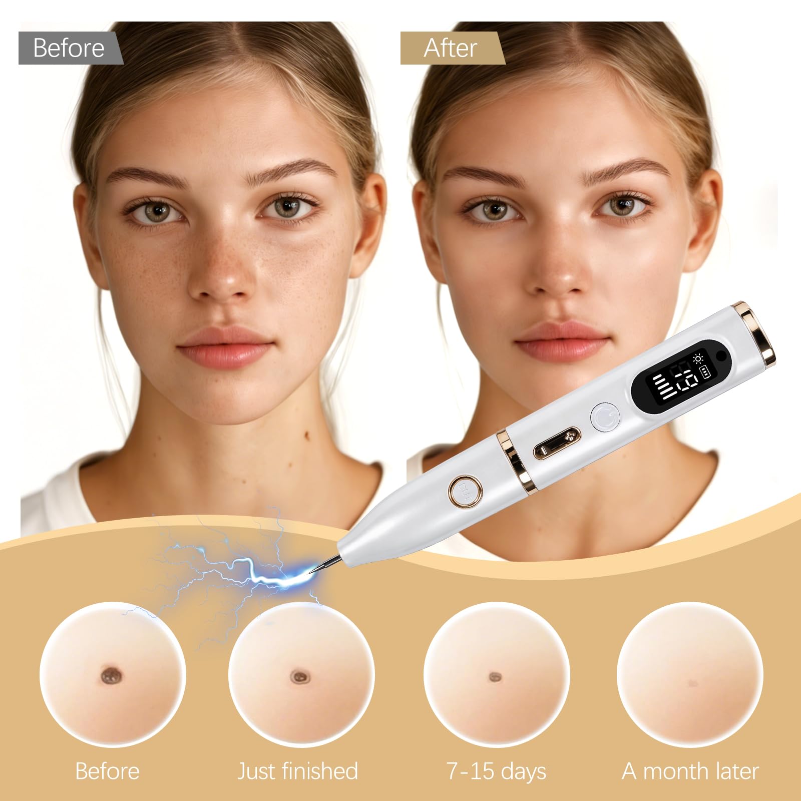 Enlèvement de Grains de Beauté Dissolvant Traitement Verrues Plasma Électrique Removal Pen avec 19 Niveaux de Puissance & LCD USB rechargeable pour Grains de Beauté, Verrues, Taches de Rousseur - 2