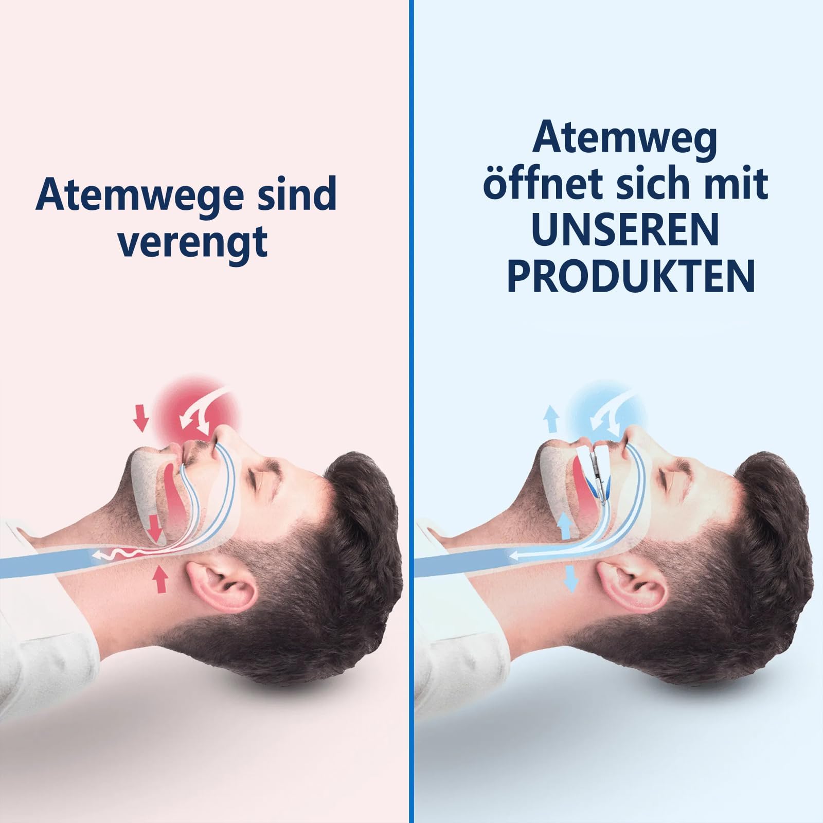 Schnarch- & Protrusionsschiene,Anti Schnarch,Schnarchstopper,Anti Schnarch Schiene Schnarchschiene (E)